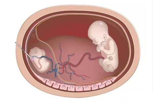 没有孩子切除子宫_切除子宫不会怀孕_试管婴儿移植成功后双胞胎减胎风险大不