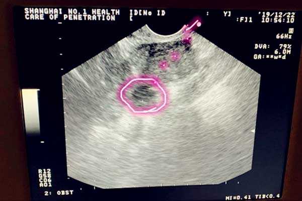 输卵管粘连怀孕率_弱精症怎么要孩子_试管婴儿取卵过程是怎么样的