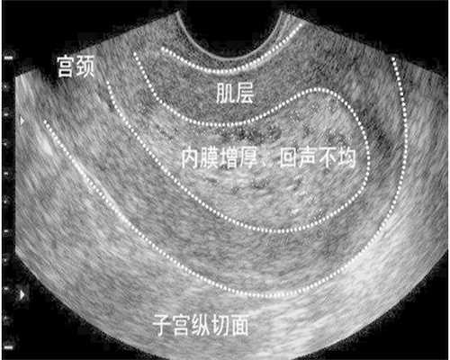 糖耐量检查不孕